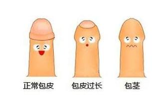 包皮过长